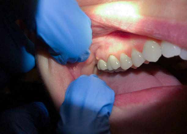 Best Emergency Gum Treatment in Saddle River, NJ